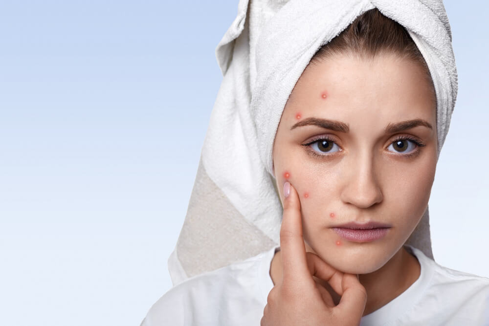 Flower Mound Acne Treatment